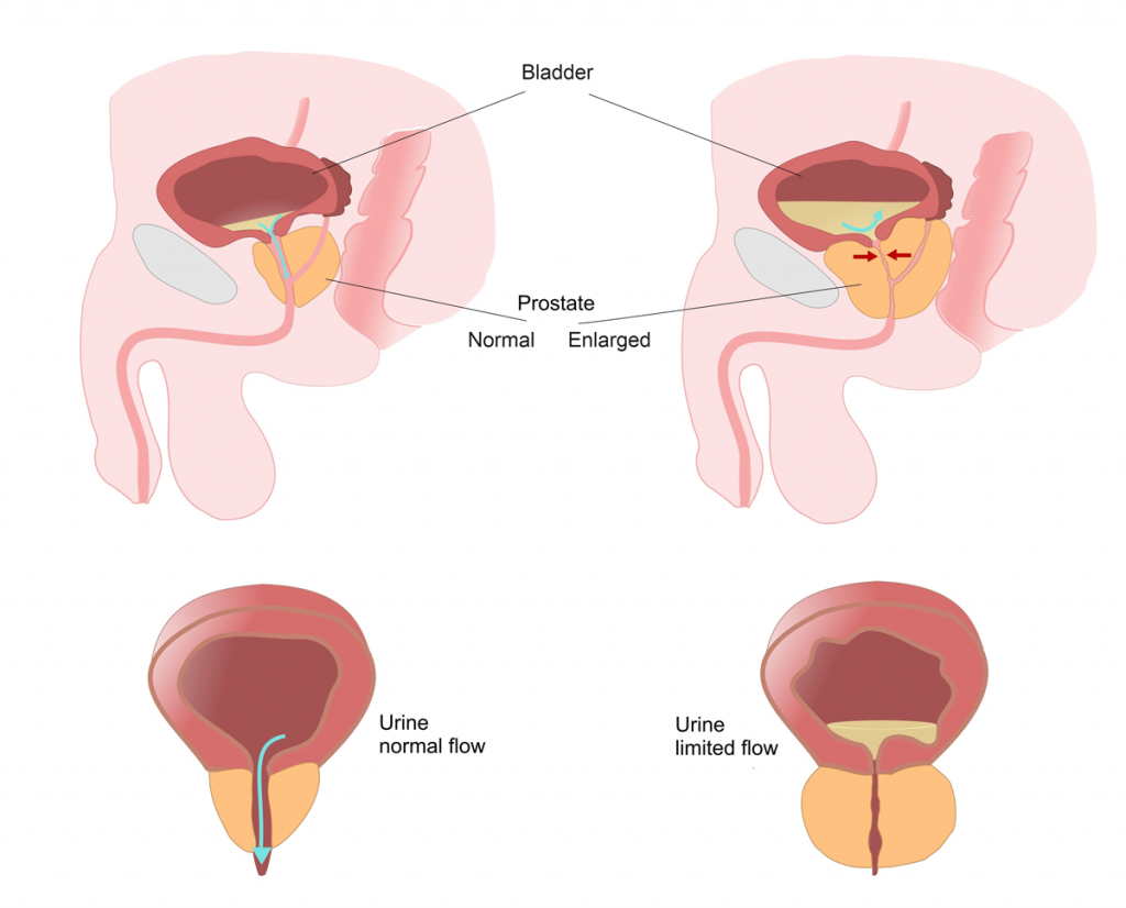 Prostate Health | Canadian Men's Health Foundation