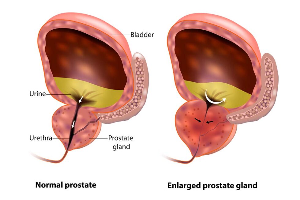 How long does an enlarged prostate last