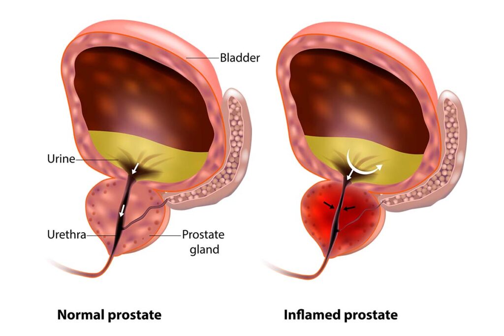 Diagram of normal vs inflamed prostate gland