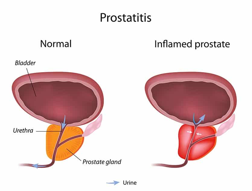 prostatitis a férfiaknál a fiatal korban)