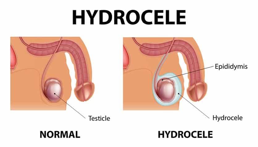 Diagram showing the difference between a normal testicle and hydrocele